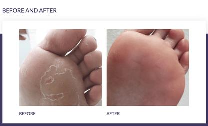 FOOTLOGIX® PEELING SKIN FORMULA