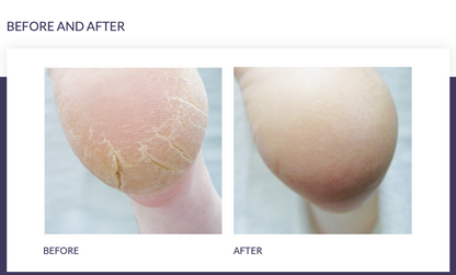 FOOTLOGIX® CRACKED HEEL FORMULA