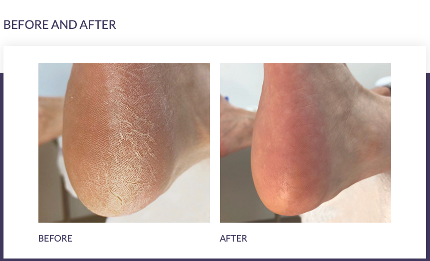 FOOTLOGIX® ULTIMATE "AT HOME" FOOT CARE COMBO